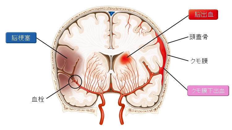 脳卒中のイメージ写真